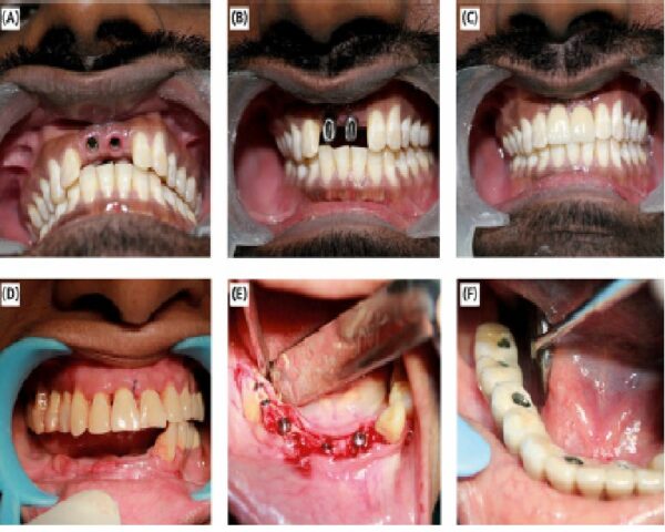 Pemasangan Implan Gigi (Dental Implant)